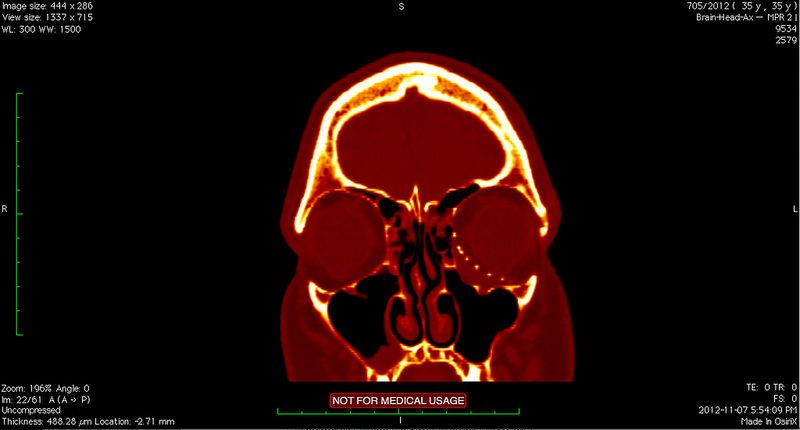 CT scan from after my third surgery